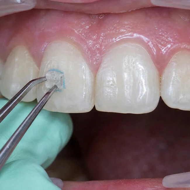 Braces Braces