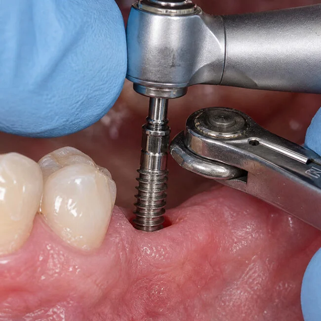 Dental Implants Dental Implants