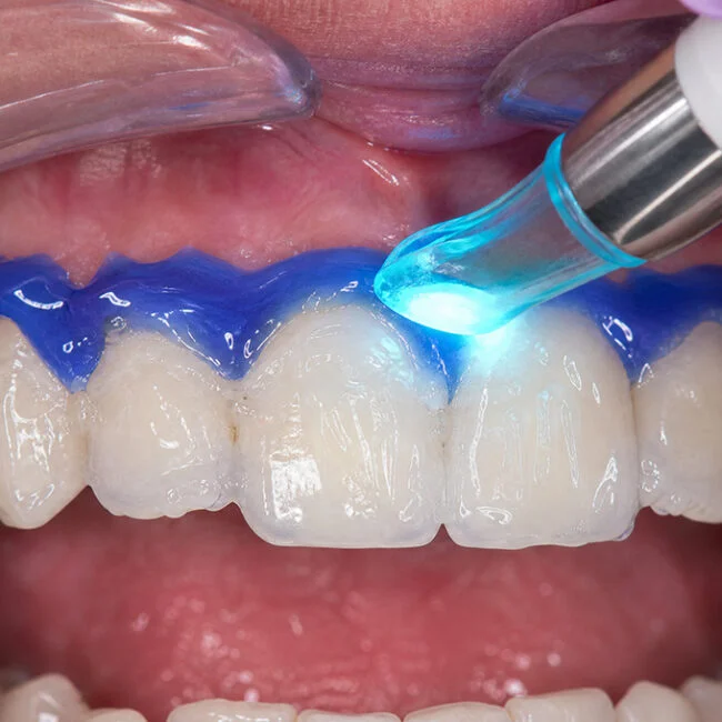 Laser Teeth Whitening Laser Teeth Whitening