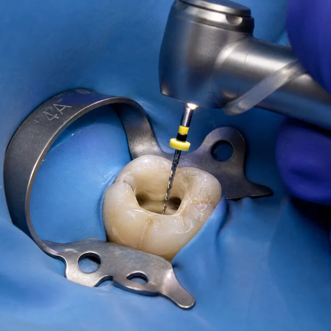Root Canal Treatment Root Canal Treatment
